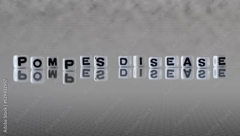 Pompe Disease Overview and Treatment Options
